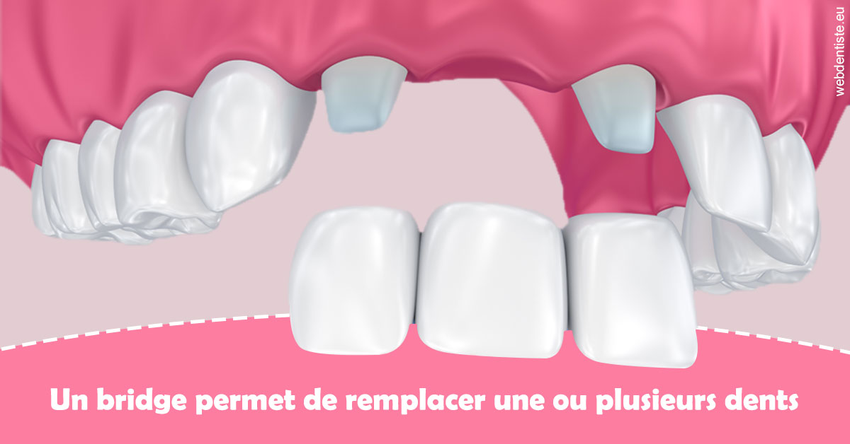 https://www.orthodontiste-charlierlaurent.be/Bridge remplacer dents 2