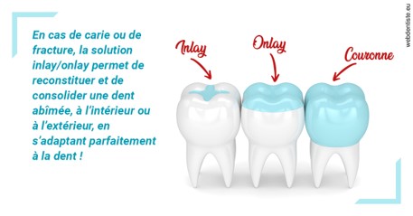 https://www.orthodontiste-charlierlaurent.be/L'INLAY ou l'ONLAY