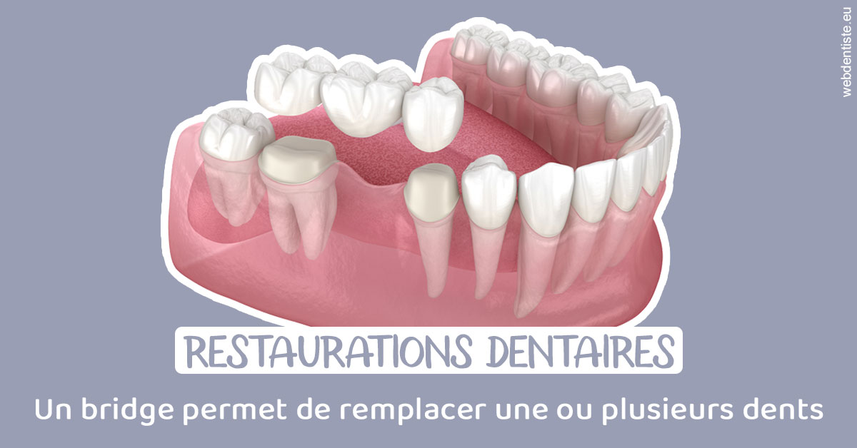 https://www.orthodontiste-charlierlaurent.be/Bridge remplacer dents 1