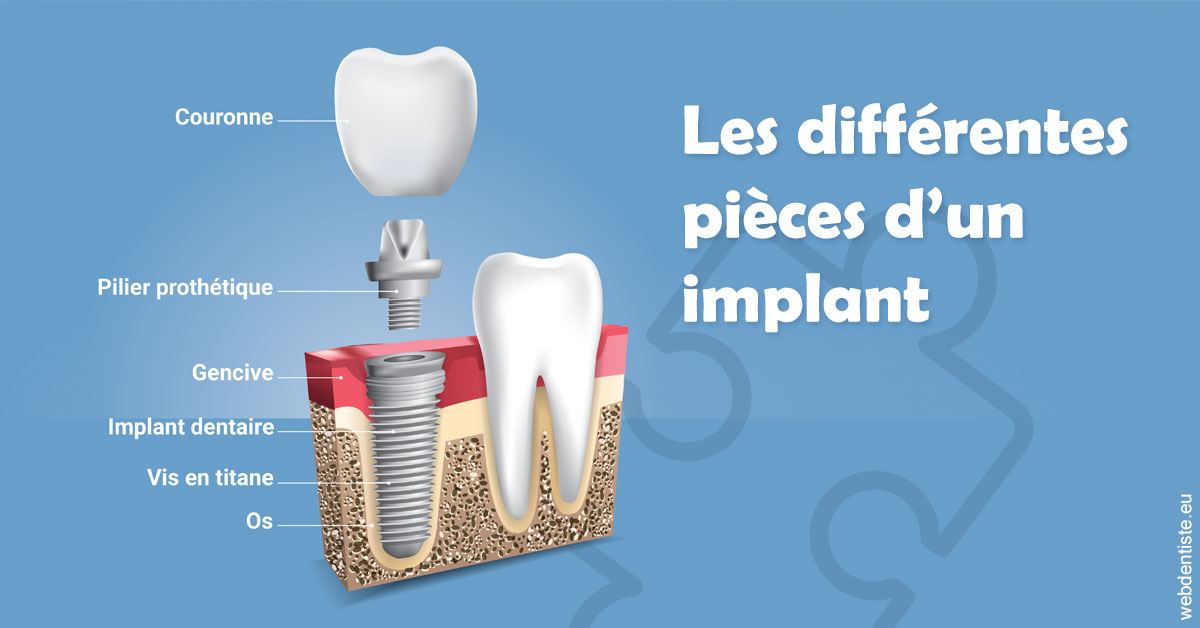 https://www.orthodontiste-charlierlaurent.be/Les différentes pièces d’un implant 1