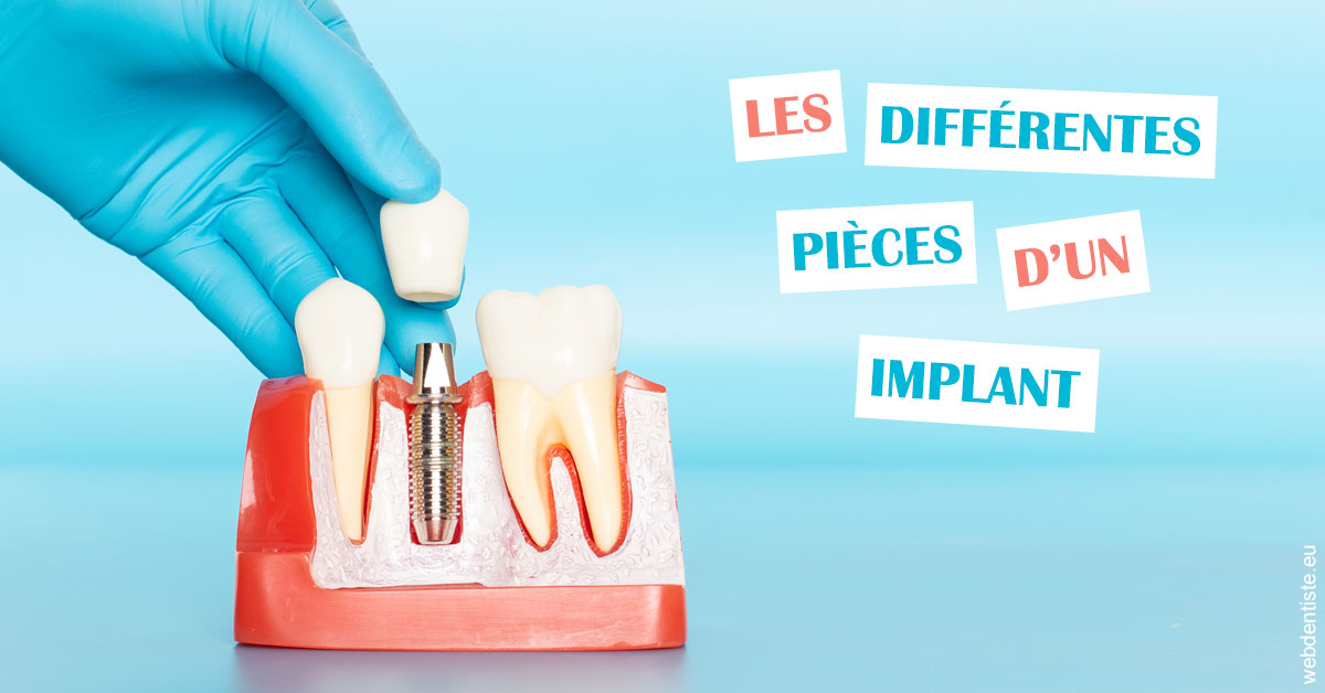 https://www.orthodontiste-charlierlaurent.be/Les différentes pièces d’un implant 2