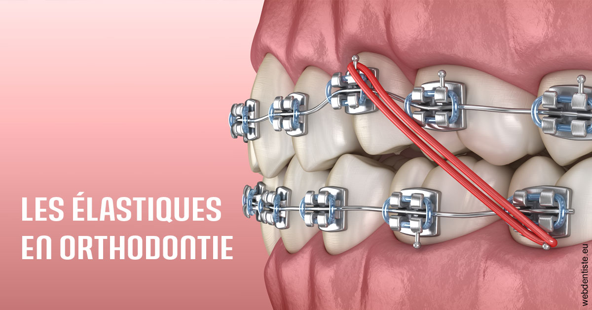 https://www.orthodontiste-charlierlaurent.be/Elastiques orthodontie 2